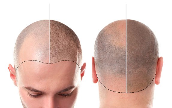 Le 10 migliori acconciature per capelli fini e lisci Tricopigmentazione - soluzione facile e veloce per ogni problema