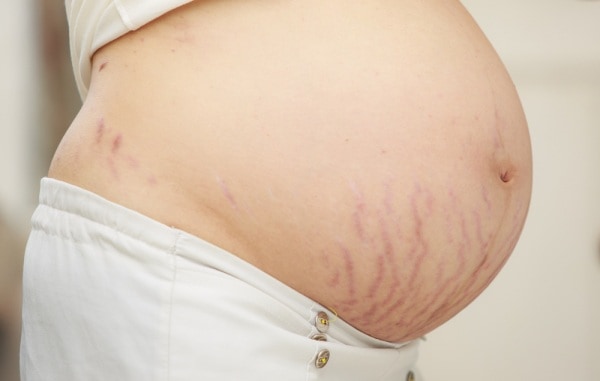 Read more about the article Come prevenire le smagliature in gravidanza