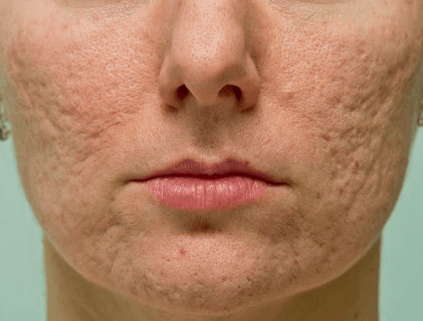 Read more about the article Come eliminare le cicatrici dell’acne